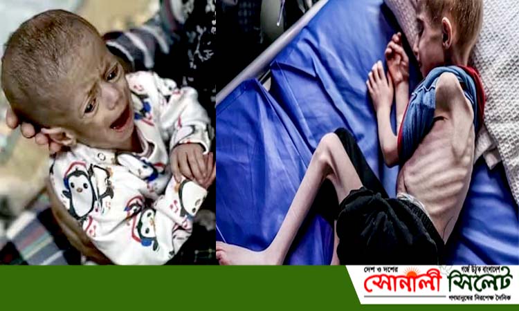 খাদ্যের অভাবে কঙ্কালসার হয়ে গেছে গাজার শিশুরা